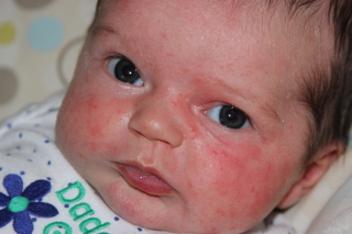 শিশুদের Heat rash হওয়ার কারণ এবং এ প্রতিকারের উপায়